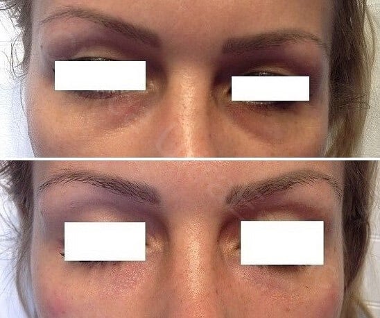Rezultate tratament cearcane acid hialuronic Bucuresti - Clinica UltraEstetic