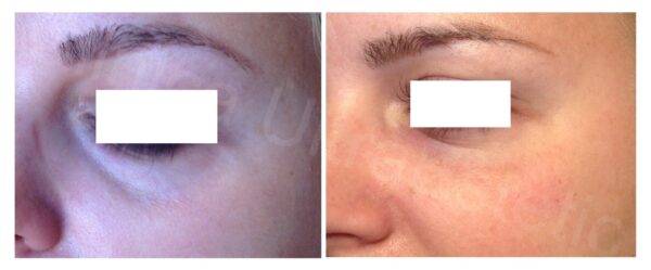 Umplere cearcane cu acid hialuronic inainte si dupa tratament - Clinica UltraEstetic Bucuresti