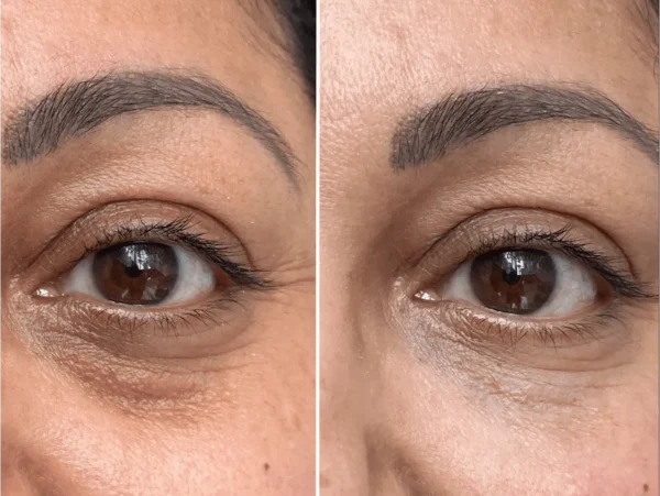 Rezultate before and after tratament polinucleotide zona ochilor - Clinica UltraEstetic Bucuresti