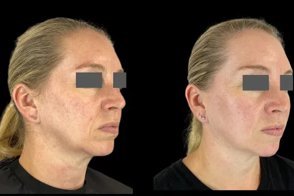 Biorevitalizare cu polinucleotide pentru maini - tratament antiaging Clinica UltraEstetic