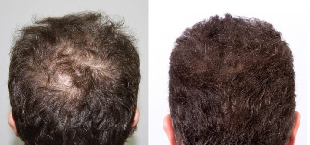 Alopecie androgenetica la barbat - crestetul capului inainte si dupa terapie regenerativa pentru scalp