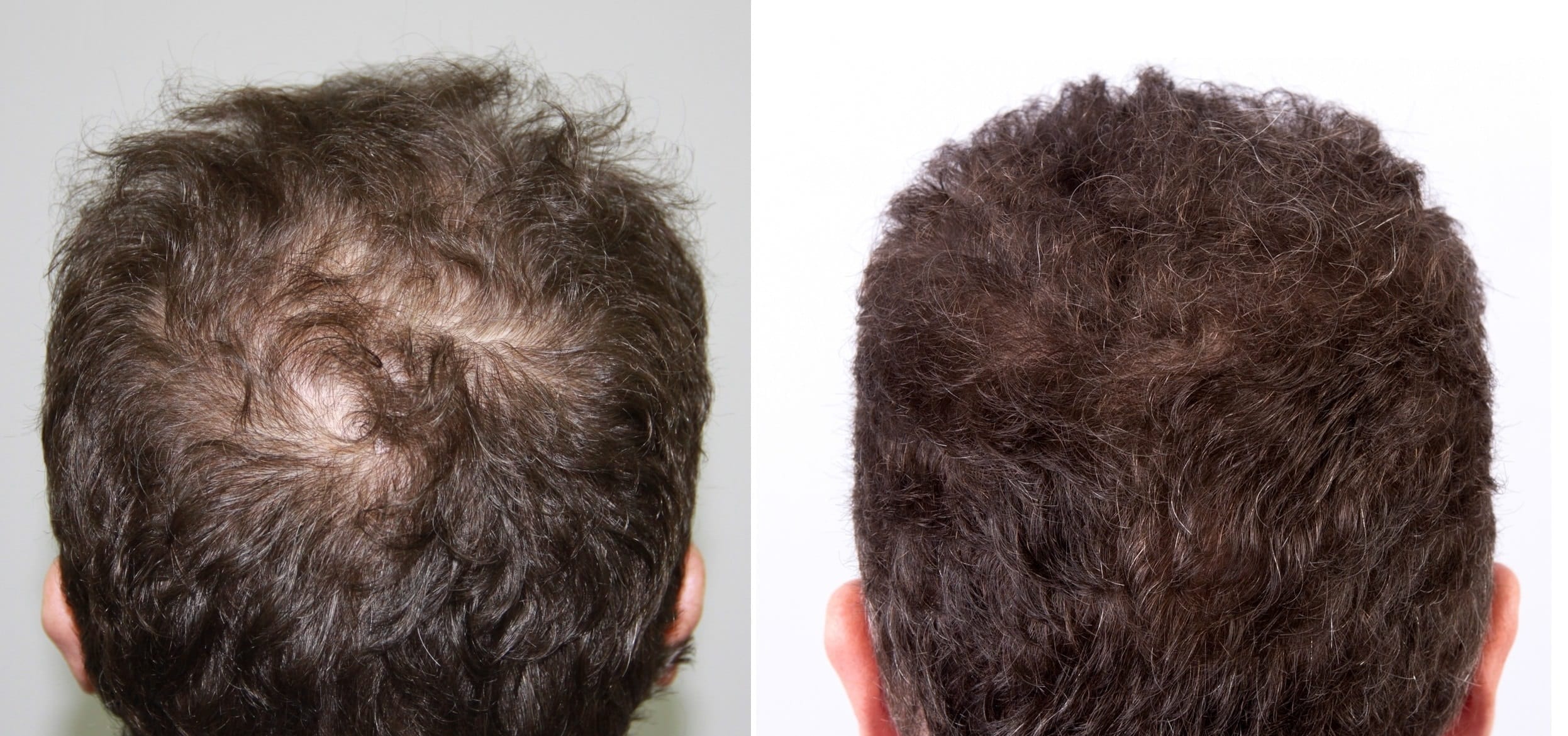 Polinucleotide pentru par si scalp Alopecie androgenetica la barbat - crestetul capului inainte si dupa terapie regenerativa pentru scalp